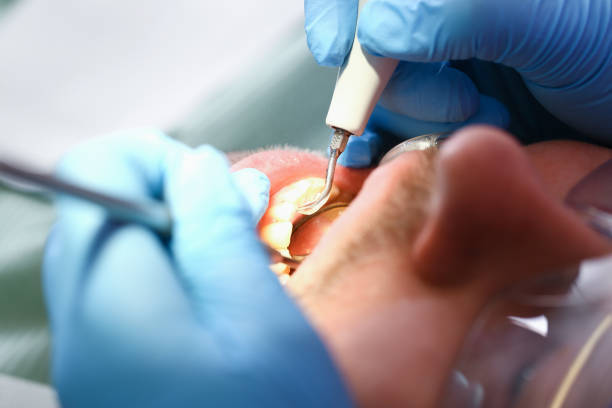Best Emergency Broken Tooth Repair in Idylwood, VA